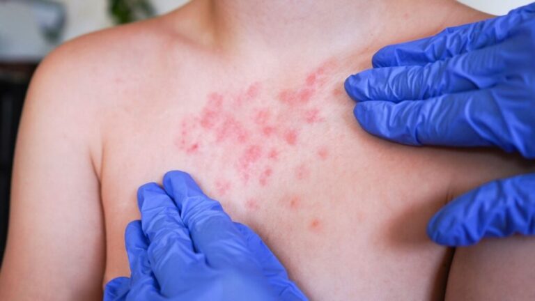 Reportan segundo caso de sarampión en Puebla; Secretaría de Salud refuerza vigilancia epidemiológica